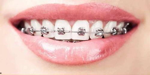 成人正畸步骤视频教学,从评估到保持的全程指导