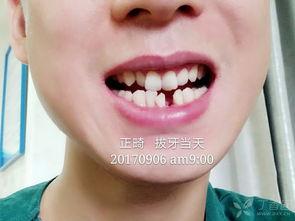 成人正畸步骤视频教学,从评估到保持的全程指导